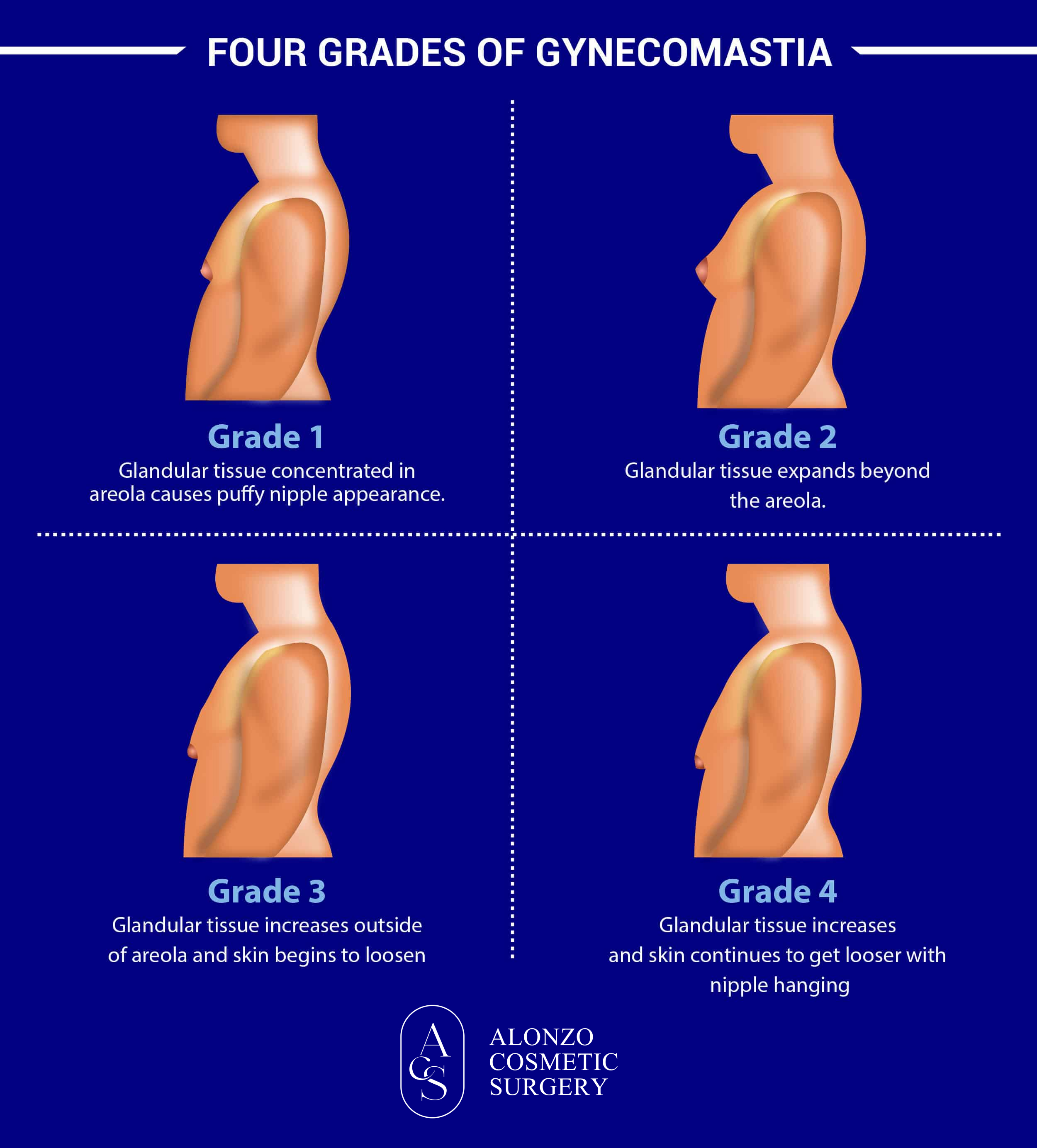 four distinct stages of gynecomastia