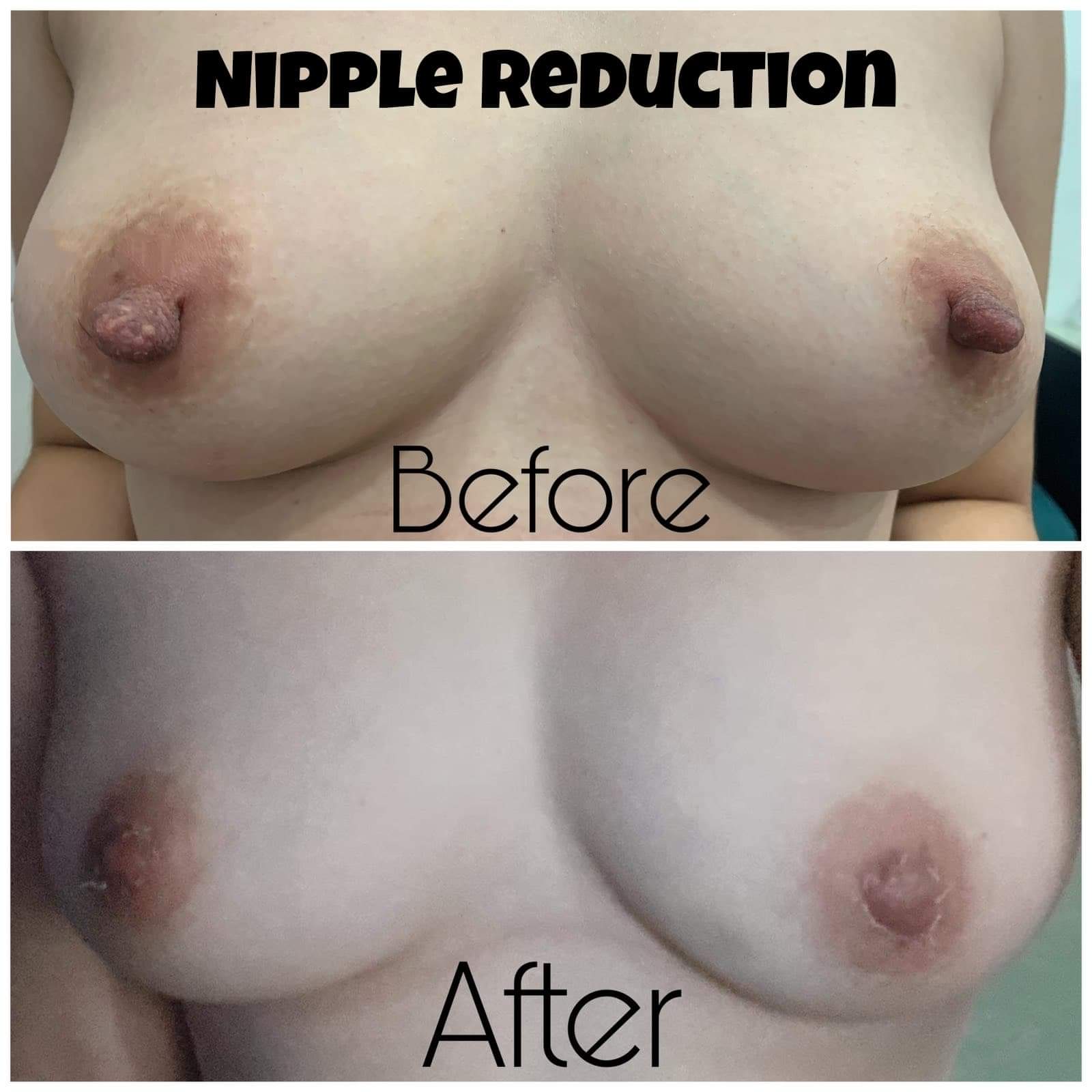 Nipple Reduction (Before and After)