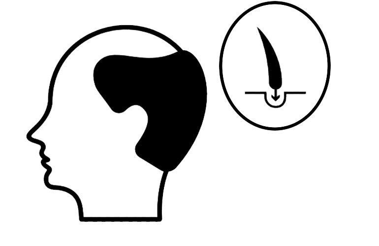 Hair Transplant