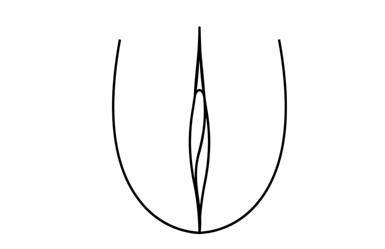 Hymenoplasty